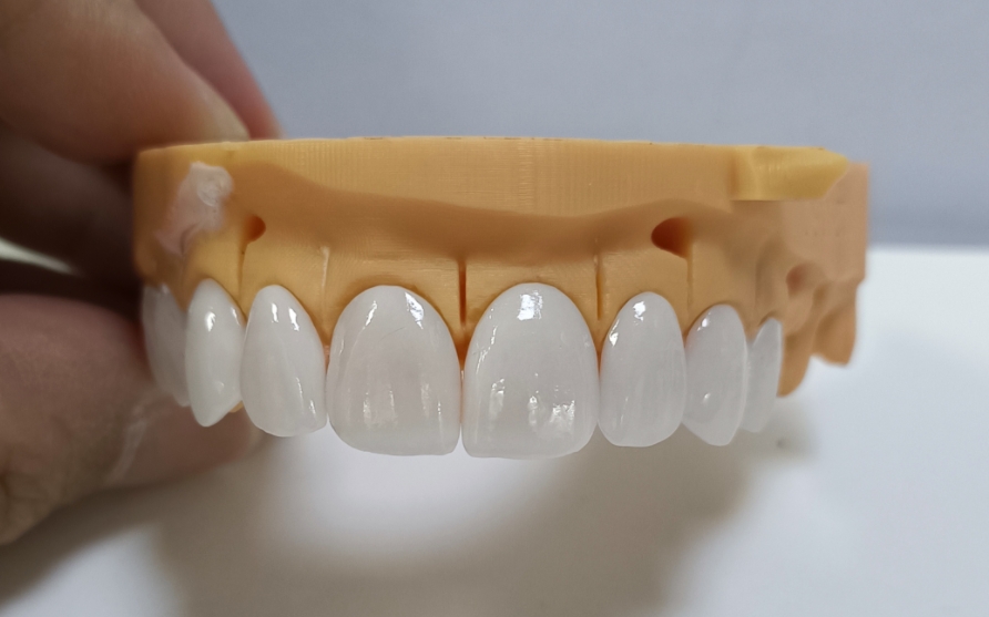 उच्च एस्थेटिक Emax Veneers
