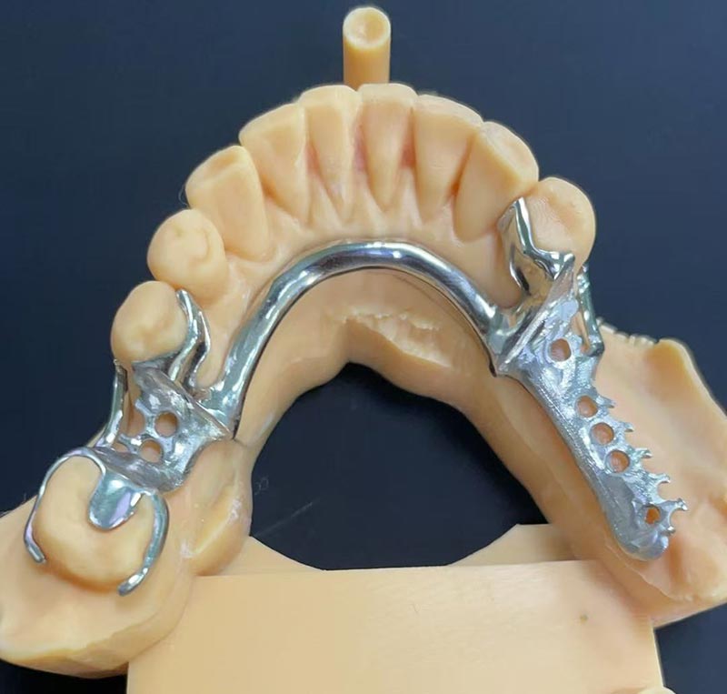 कोबाल्ट-क्रोमियम फ्रेमवर्कका फाइदाहरू (Co Cr फ्रेमवर्क)