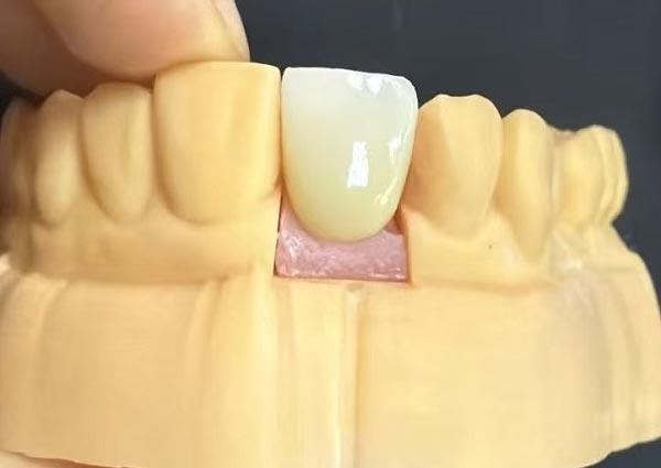 दाँत बिचको ग्याप फिक्स गर्न सकिन्छ—सीधा दाँत सबैभन्दा आकर्षक हुन्छ!