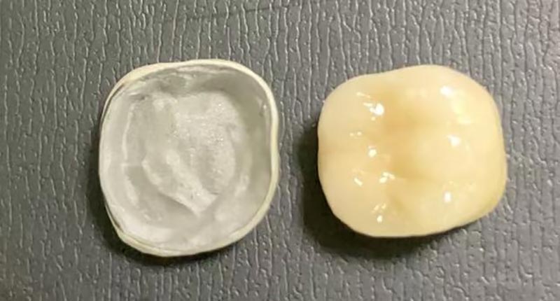 तपाईंको पोर्सिलेन क्राउन चिप्स हुँदा के गर्ने? यहाँ छ किन यो हुन्छ र यसलाई कसरी ठीक गर्ने