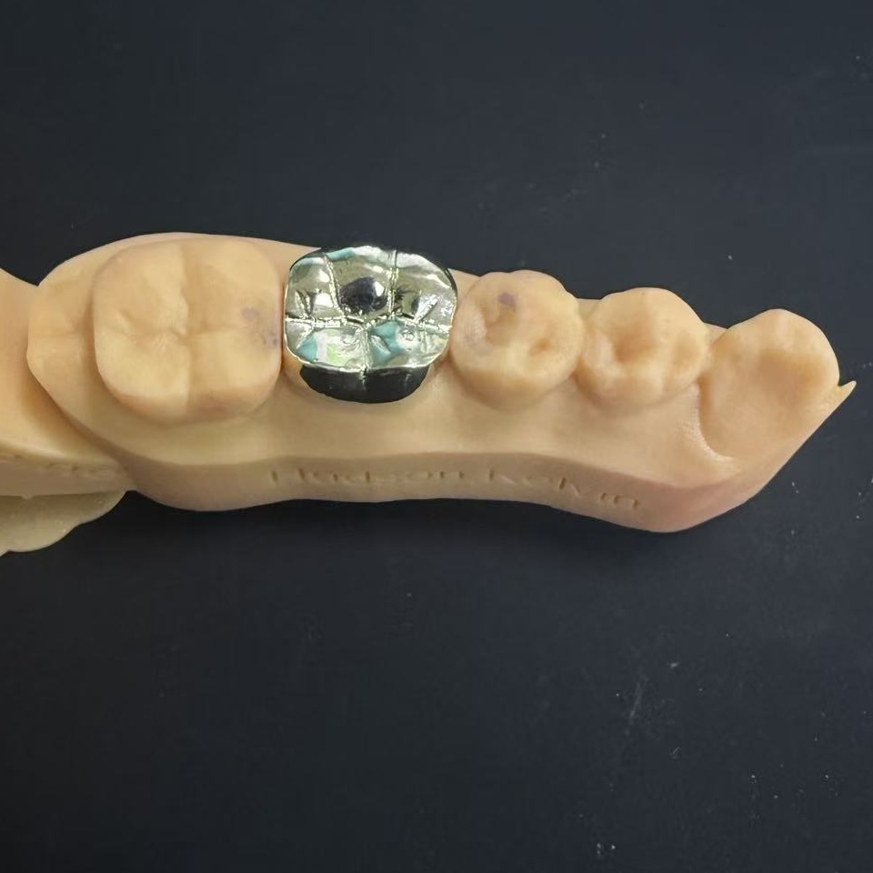 सुनको मुकुट: जीवनभर दन्त पुनर्स्थापनाको लागि बहुमूल्य धातु विकल्प