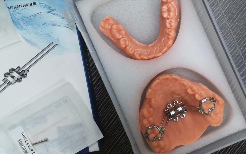 WM डेन्टल ल्याबको साथ MSE स्केलेटल विस्तार बुझ्नुहोस्