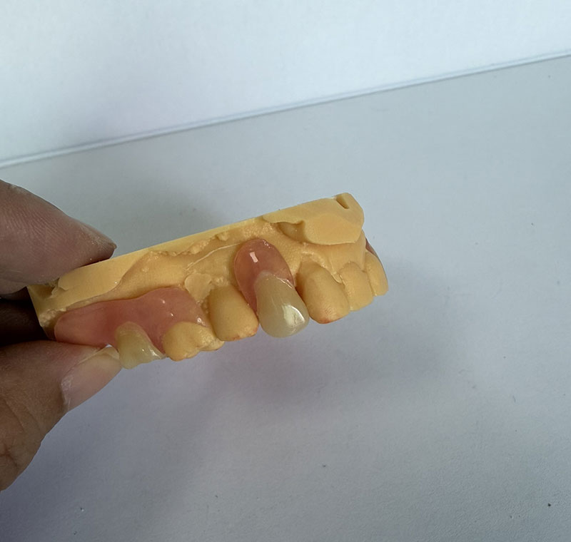 WM दन्त प्रयोगशालामा Valplast Partials