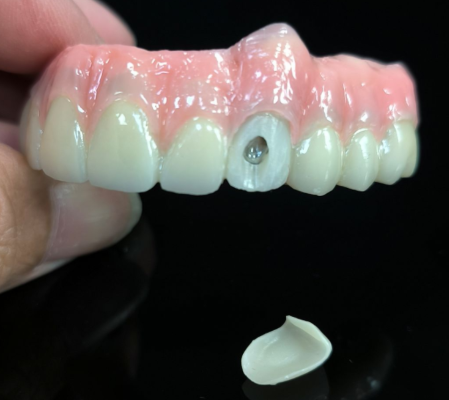 सबै hylbrible हाइब्रिड - usbriid zirconiaia ब्रिन्सिया ब्रिज समाधानको लागि vidsbulars स्क्रू प्वालहरूको लागि