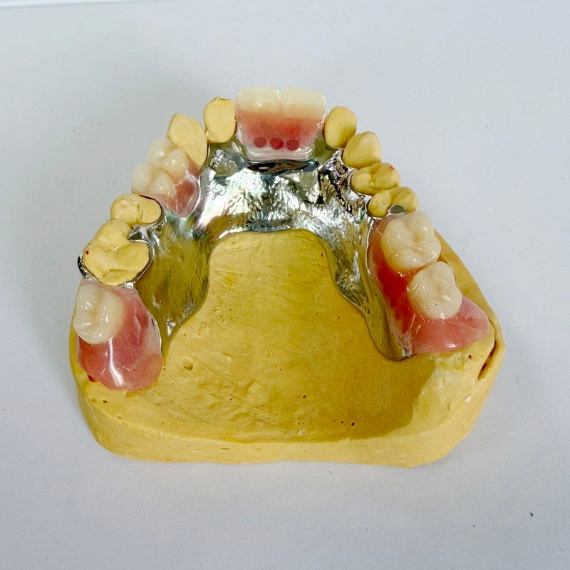 हटाउन सकिने पुनर्स्थापना आंशिक फ्रेमवर्क